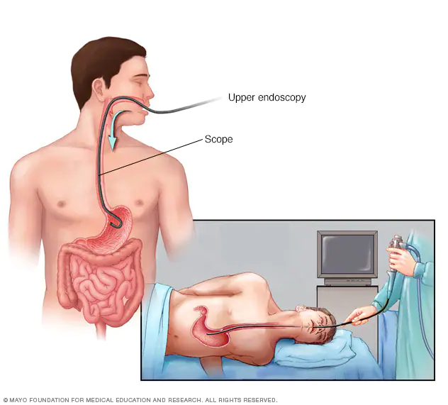 Descodificació de la salut digestiva: el poder de l'endoscòpia