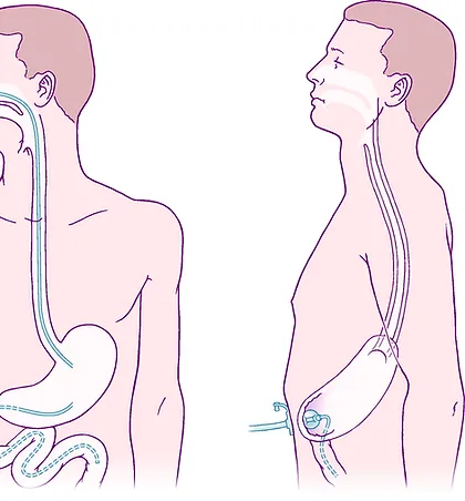Gastrostomia percutània endoscòpica