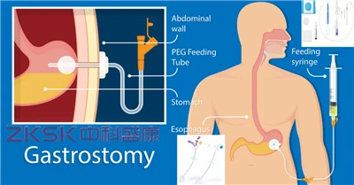 Alimentació amb sonda G: vides nutritives, cura transformadora